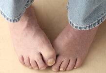 Egészségsarok – Körömgomba